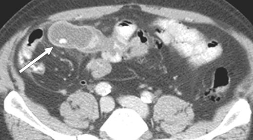 and, xial CT scans show enterolith (arrow, ) in dilated