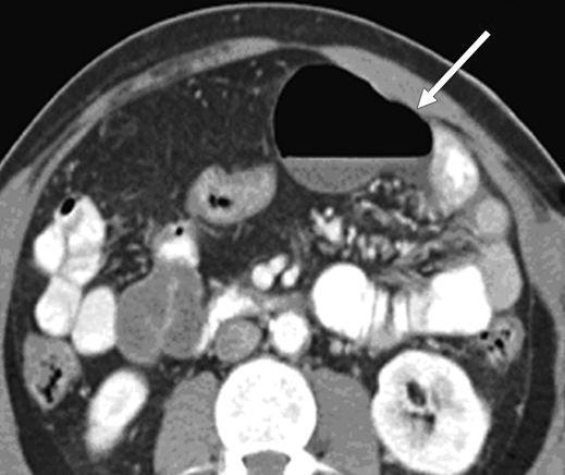 11 28-year-old woman with vomiting and abdominal pain.