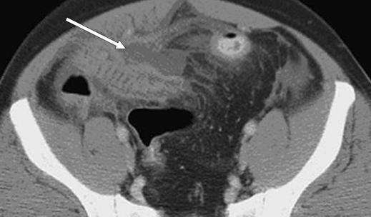 ) with small abscess (arrow, and C).