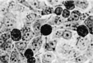 288 K. KARTHIKEYAN ET AL. Fig. 2. Giemsa stained HFS cells after treatment with EE for 24 h. Cells with condensed nuclei were shown by ( ) and fragments by ( ). magnification 200.
