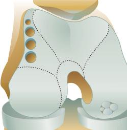 Osteochondral Autograft Transfer System (OATS )