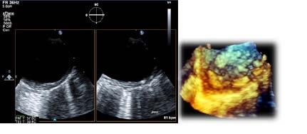 The Estimation of Aortic Atheromas by TEE: Do 3D Images Better Estimate Atheromas' Size?