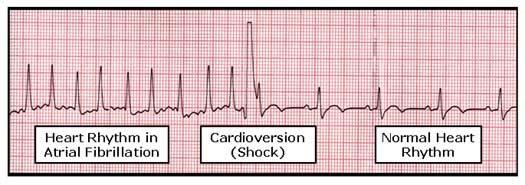 Definition of Cardioversion Cardioversion is an electrical method to restore a rapid heart beat back to sinus rhythm.
