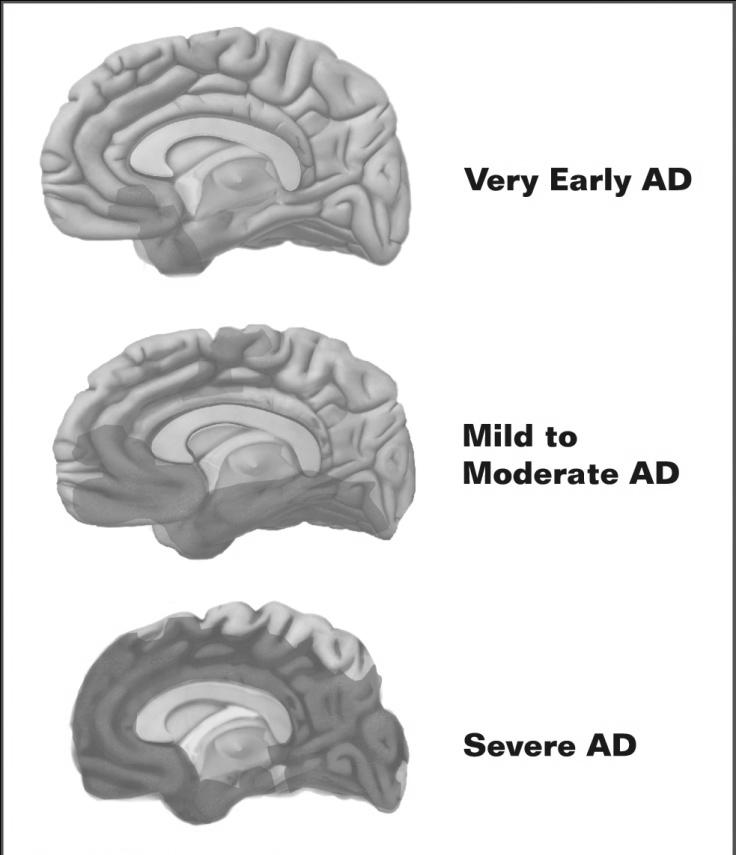 As Alzheimer s disease progresses, neurofibrillary tangles spread throughout the brain (shown in shadow portion). Plaques also spread throughout the brain, starting in the neocortex.