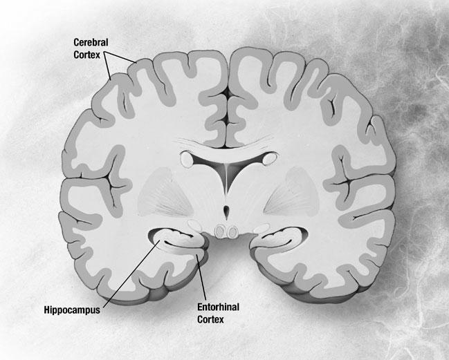 CHANGES IN THE BRAIN: PRECLINICAL Alzheimer s disease begins in the entorhinal cortex which lies deep in the brain.