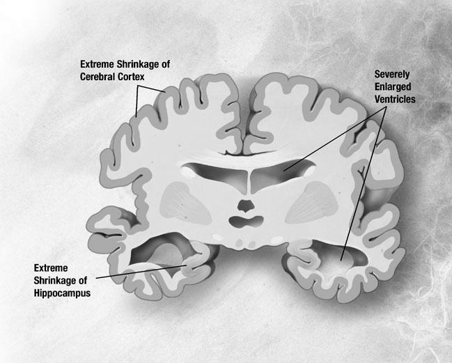CHANGES IN THE BRAIN: SEVERE ALZHEIMER S Changes in the brain with severe Alzheimer s disease are pronounced. Plaques and tangles are widespread throughout the brain.
