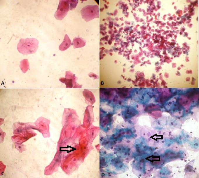 Page141 Fig: 1. Photomicrograph of oral cytology smears of A. Group N showing normal cytology (Pap, X 400) B.