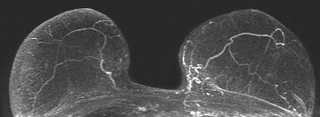 Potential techniques as adjunct to mammography for personalized screening in women with dense breasts: 1)