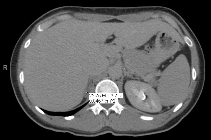 Radiology CT Abdomen w/ and w/o contrast 09/14/2015: - Right adrenal gland lesion measuring 1.3 x 0.