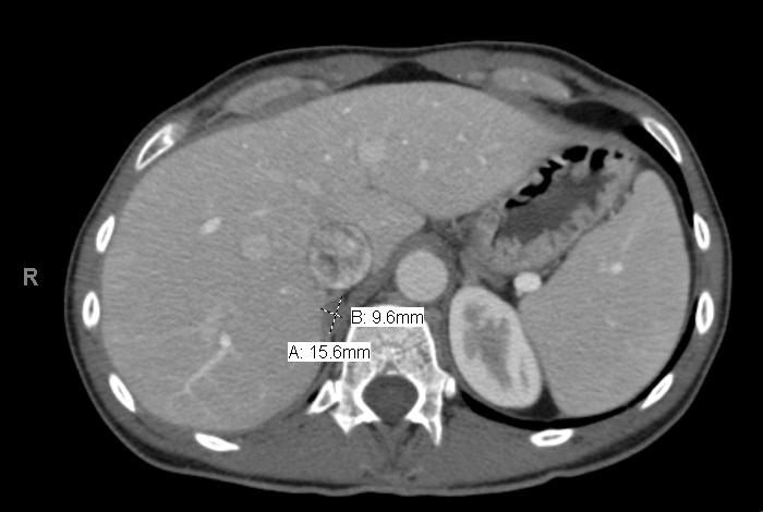 Radiology CT Abdomen w/ and w/o contrast 07/14/16: - Right adrenal gland lesion