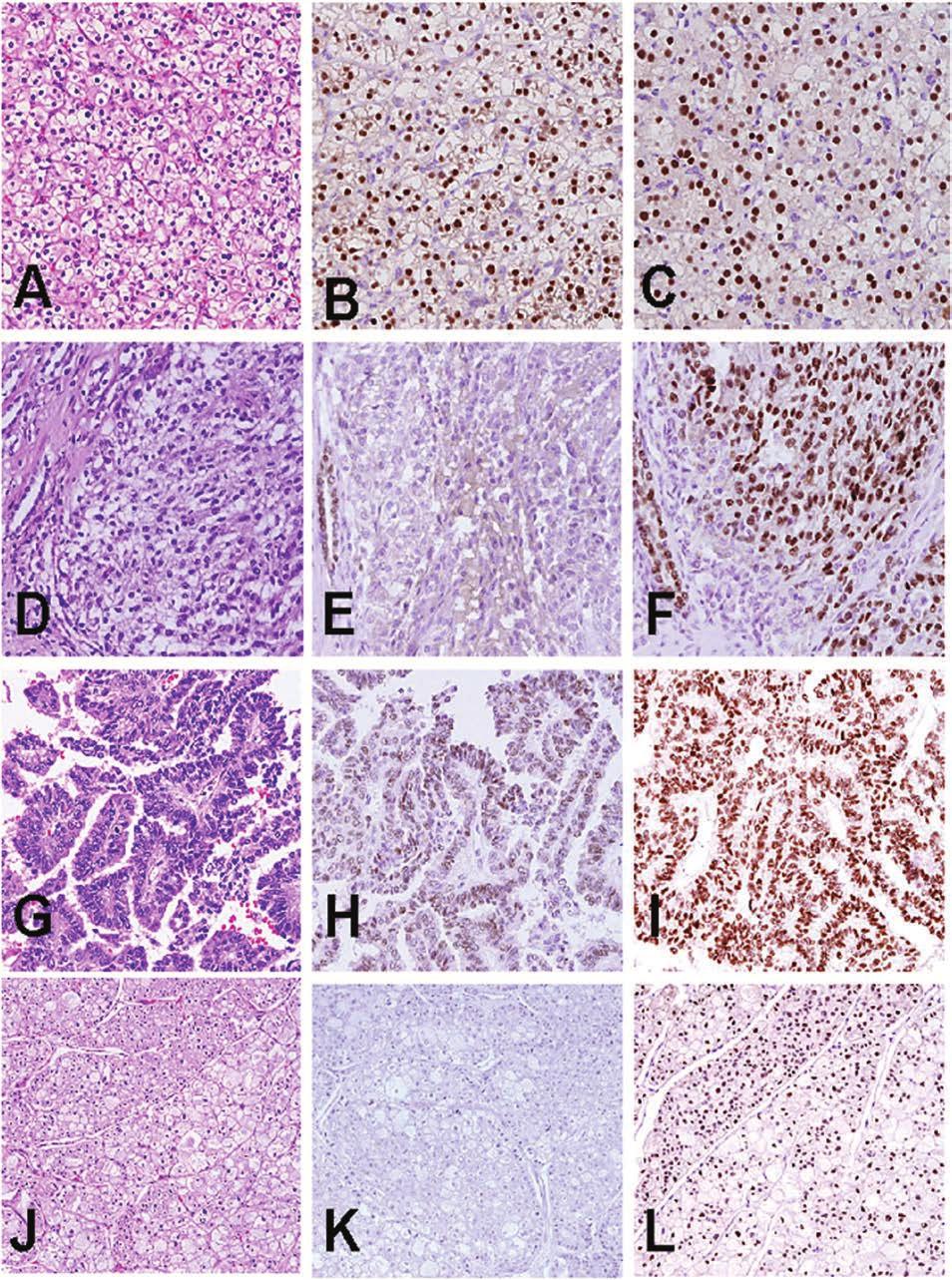 Figure 1. A through C, Clear cell renal cell carcinoma (RCC); diffuse and strong staining for both PAX2 and PAX8.