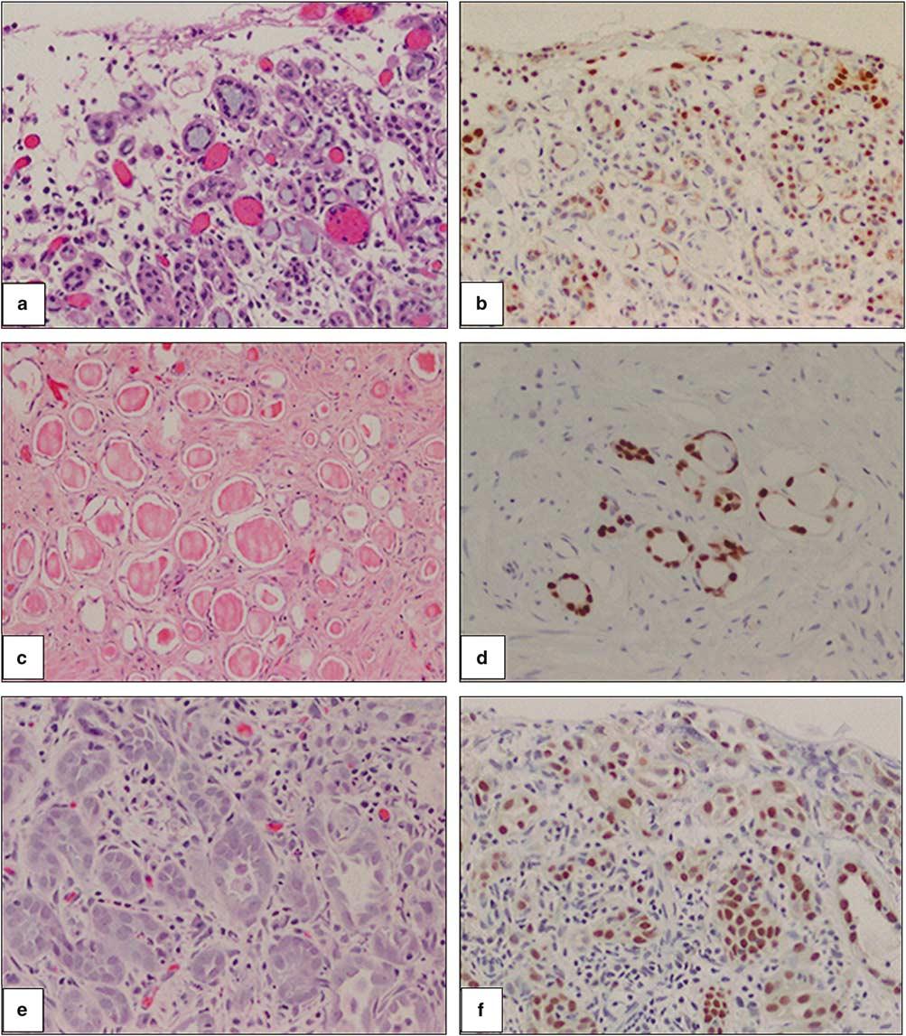 360 Figure 4 Expression of PAX2 in nephrogenic adenoma with atypical features.
