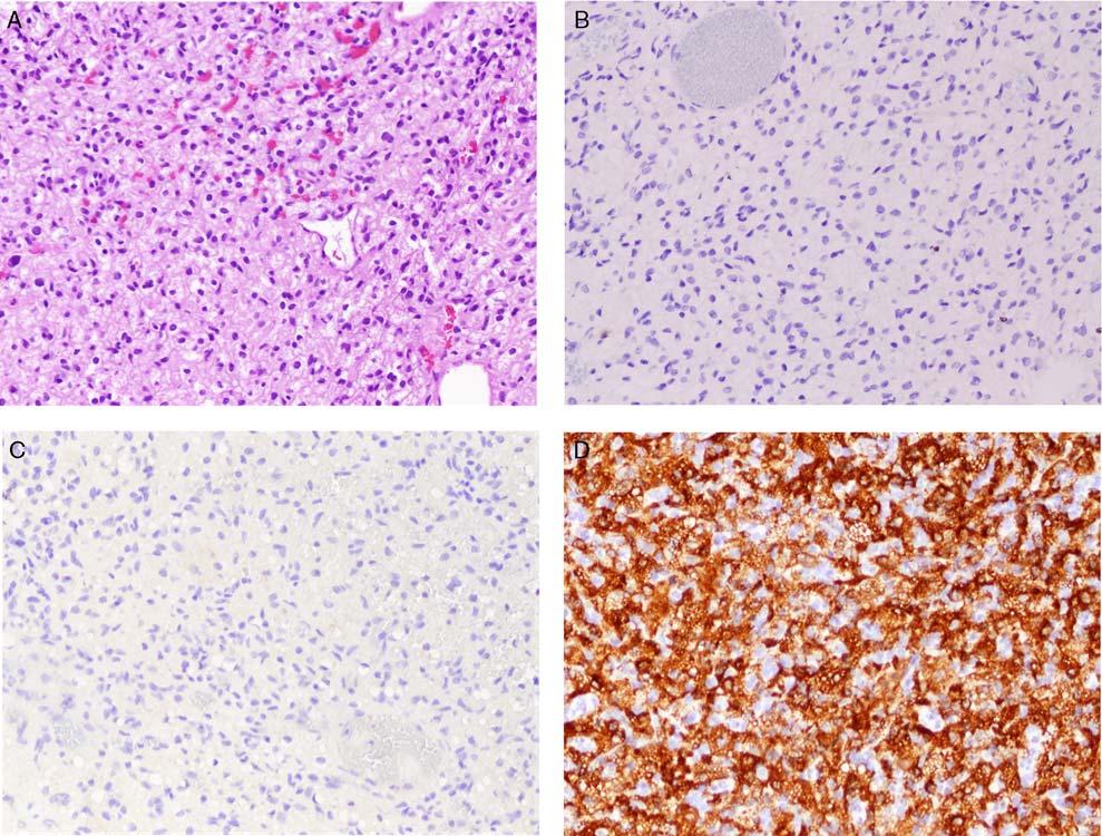 Am J Surg Pathol Volume 35, Number 2, February 2011 PAX2, PAX8, and Inhibin A Combination in Hemangioblastoma TABLE 4.