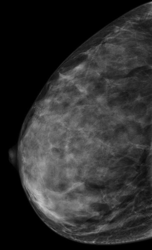 Mammography is the most reliable imaging technique for breasts, but limitations can exist due to breast density.