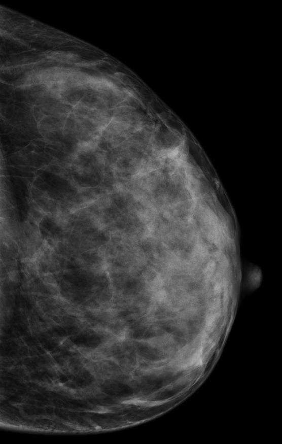 For a final diagnosis, radiologists often need complementary imaging, such as breast MRI.