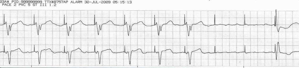 Threshold Level The minimum stimulus required to cause stimulation of the myocardium (pacing) or minimum voltage for an intrinsic complex to be sensed.