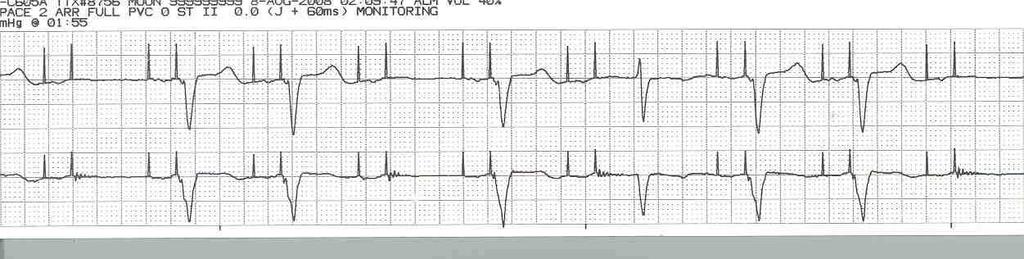 the pacemaker s electrical stimulus To assess capture it is necessary to see pacemaker spikes followed by depolarization For example an atrial spike followed by a p wave or a ventricular spike