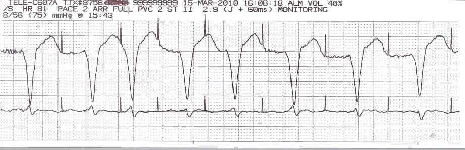 Sensing/Sensitivity Sensing is the ability of the pacemaker to see when an intrinsic depolarization is occurring.