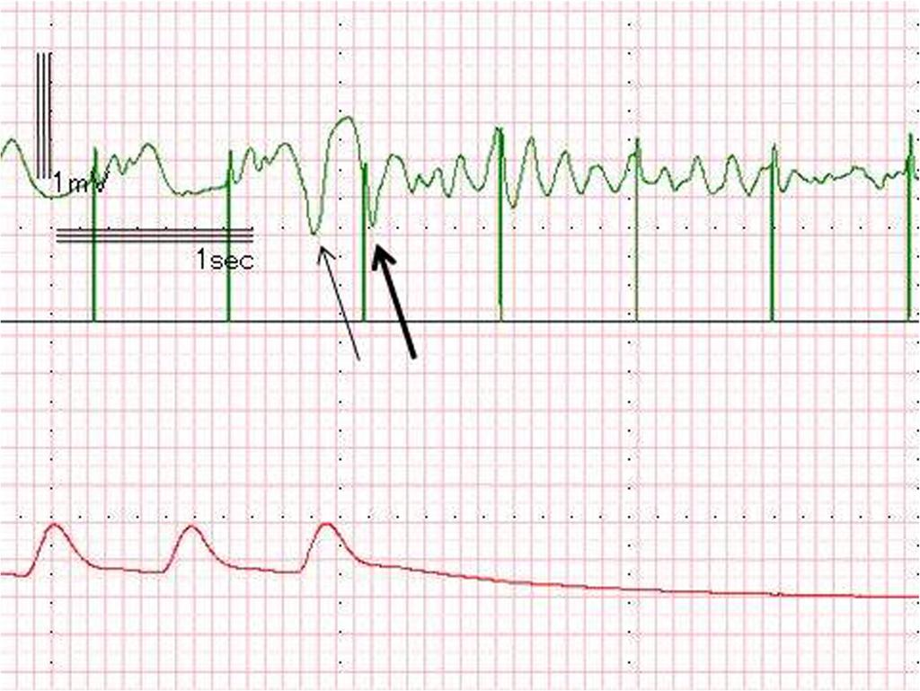 Each AOO pacing spike captures a P wave, but every third P wave does not induce a QRS wave Fig.