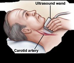 ultrasound Plaque
