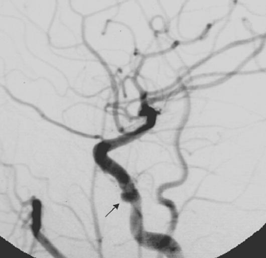 CT of Internal Carotid Artery Injury A B Fig. 1. True-positive CT finding for internal carotid artery (ICA) injury in 51-year-old man who was ejected from automobile during motor vehicle accident.