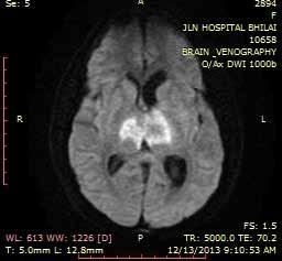 sinus abnormalities on MRI/MRV Sinus involved No.