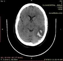 Journal of The Association of Physicians of India Vol. 65 November 2017 19 Table 6: Sinus and parenchymal abnormality on and MRI Fig. 3a: Hemorrhagic infarct seen on plain head CT scan Fig.