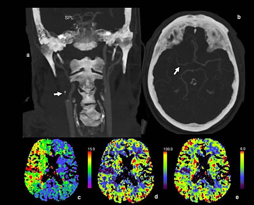307 Fig. 3. Seventy minutes after onset and of left-sided hemiparesis and neglect after 8 h of fluctuating symptoms (patient 2). CT angiogram (a) shows total occlusion of the right ICA (arrow).