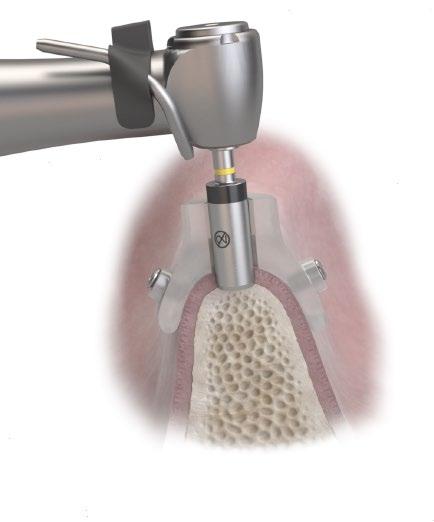 Implant site preparation Step-by-step implant placement: OsseoSpeed EV For preparation and installation of an OsseoSpeed EV implant follow the steps below: Note: All drilling, except for the Punch,