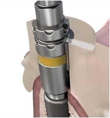 Implant site preparation Implant pick up Attach the appropriate Implant Driver EV-GS to the contra angle. Ensure that the implant driver is fully seated into the implant.