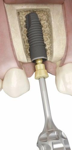 Implant site preparation EV-Stabilization Abutment For multiple implant cases, you can use the stabilization abutment to secure