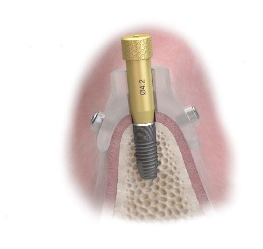 For easier removal, the abutment should be hand-tightened using the Hex Screwdriver EV.