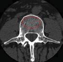 unfractured levels of the lumbar spine between T11-L4 are imaged using a standard CT scanner.