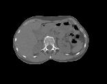 DXA-equivalent Hip Analysis A projection of the 3D CT image produces DXA-equivalent T-score and