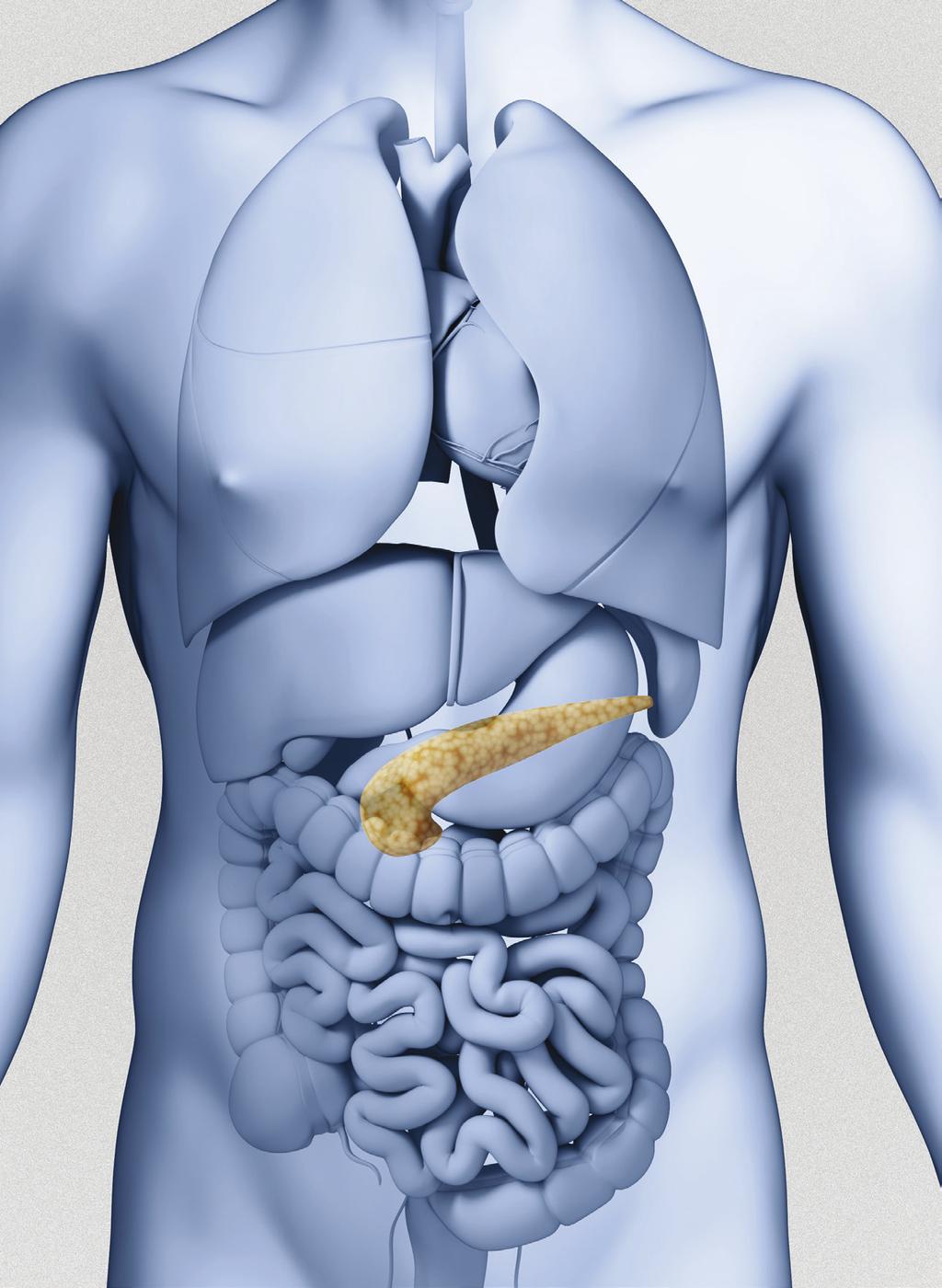 It can develop in some people who have1,5: Chronic pancreatitis (swelling of the pancreas