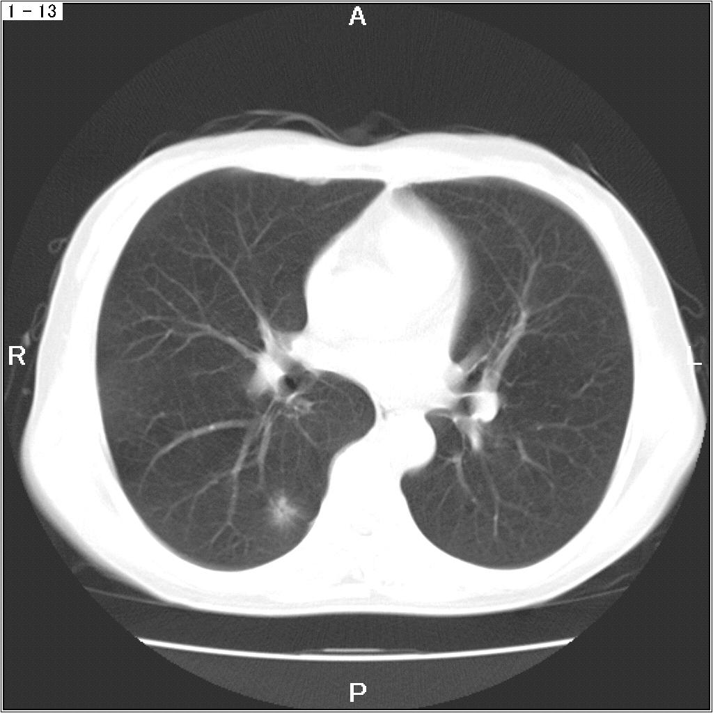 A case of part-solid nodule Minimally
