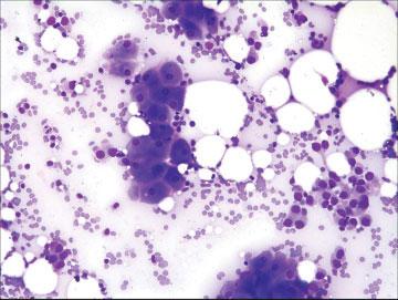 [Color figure can be viewed in the online issue, Fig. 2. Rare cluster of apocrine cells present with the tumor cells (DQ stain, high power). [Color figure can be viewed in the online issue, Fig. 3.