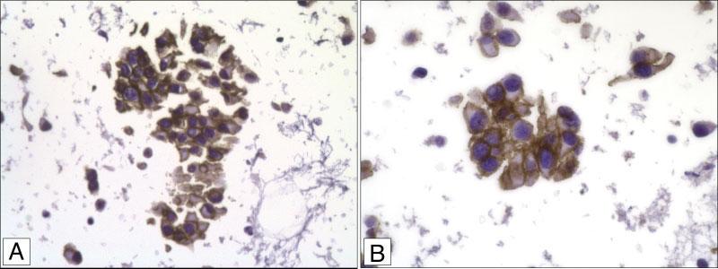 ] Fig. 5. Renal carcinoid tumor with angiolymphatic invasion (H&E stain). [Color figure can be viewed in the online issue, which is available at www.interscience.