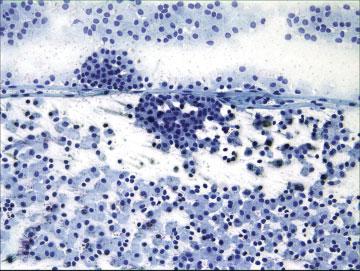 METASTATIC RENAL CARCINOID TUMOR AS BREAST MASS Fig. 7. Endobronchial carcinoid tumor with tumor cells around small sized blood vessels (Papanicolaou stain, high power).