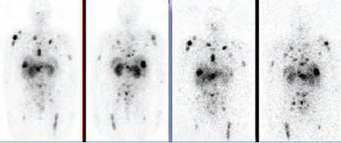 Indium In-111 Pentetreotide (Octreoscan ) Detects and localizes primaries and metastases Octreoscan image Staging of NETs Patient follow-up to evaluate recurrence Selection of