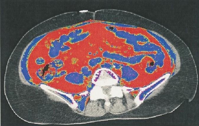 Visceral Adipose Tissue (VAT) by Computed Tomography African American vs