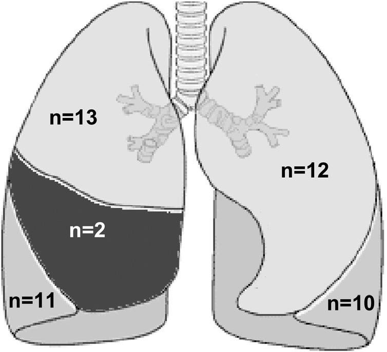 Respiratory-gated 18 F-FDG PET imaging in lung cancer: effects on sensitivity and specificity 3 Fig.
