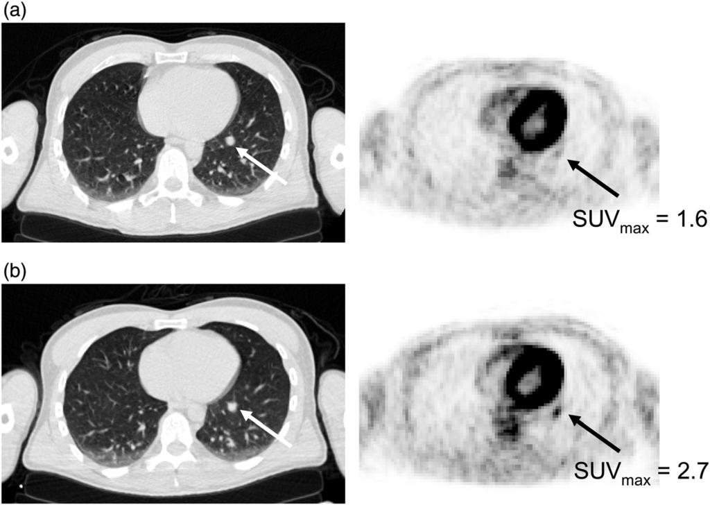 Respiratory-gated 18 F-FDG PET imaging in lung cancer: effects on sensitivity and specificity 5 Table 2.