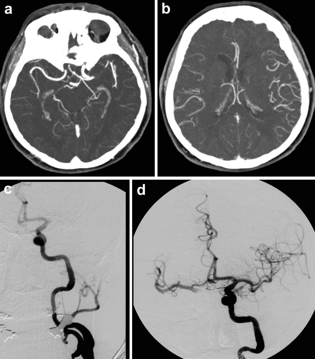 Background Cerebral hyperperfusion syndrome (chs) is a well known but rare complication after carotid endarterectomy, carotid A angioplasty with stenting, and stenting of intracranial arterial