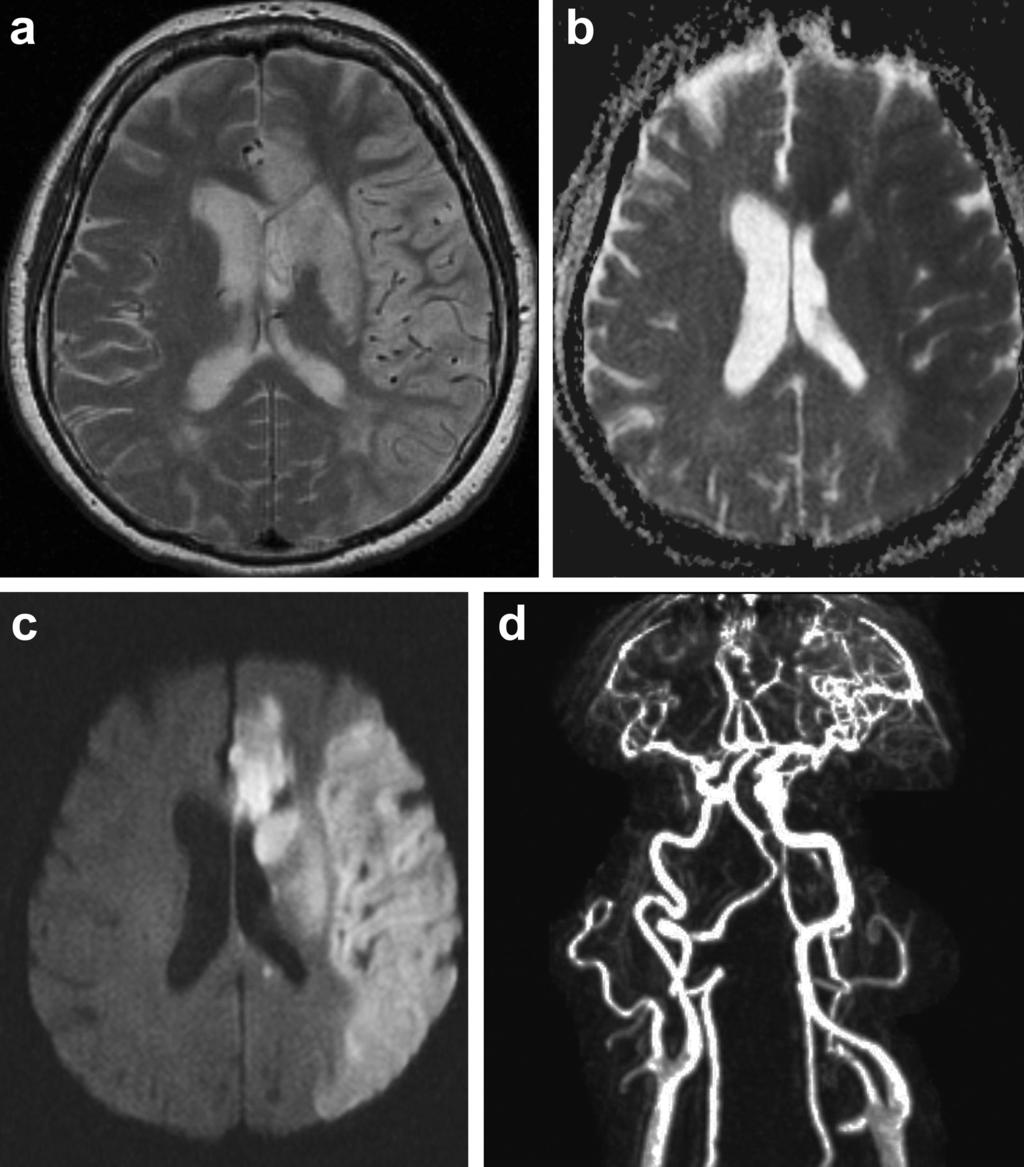 A B C D Figure 2. (A) T2-weighted MRI 6 days later demonstrates partial left ACA ischemia and basal ganglia and a homogenous lesion of left MCA territory sparing the subcortical white matter.