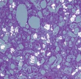 Tumour cells usually have abundant granular, eosinophilic cytoplasm and large nuclei with prominent nucleoli.