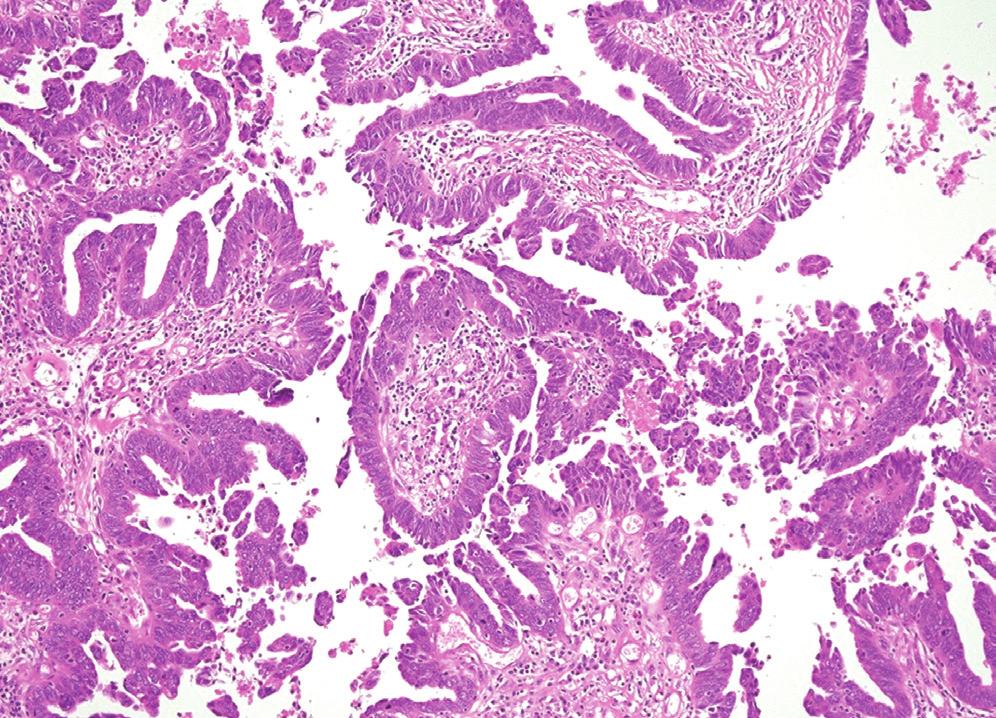 The bilateral ovarian and perirectal tumors were histologically characterized by complex and interconnecting papillary structures lined by stratified malignant epithelial cells showing marked