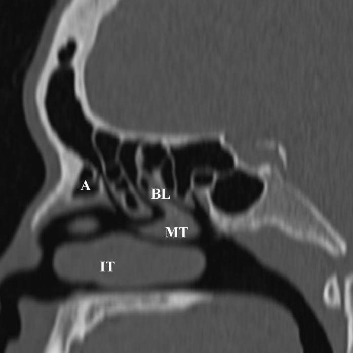 DRAINAGE PATHWAYS Ostiomeatal Units Anterior Middle Meatus Frontal sinus Maxillary sinus