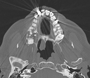 20% associated with Dentigerous cyst & unerupted teeth Locally