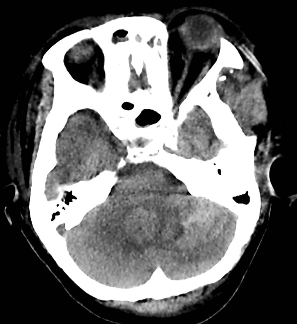 Computed tomography and magnetic resonance imaging showed hemorrhage in the left cerebellar hemisphere with surrounding edema (Fig. 1B, C).